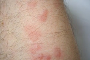 Bed bug bites